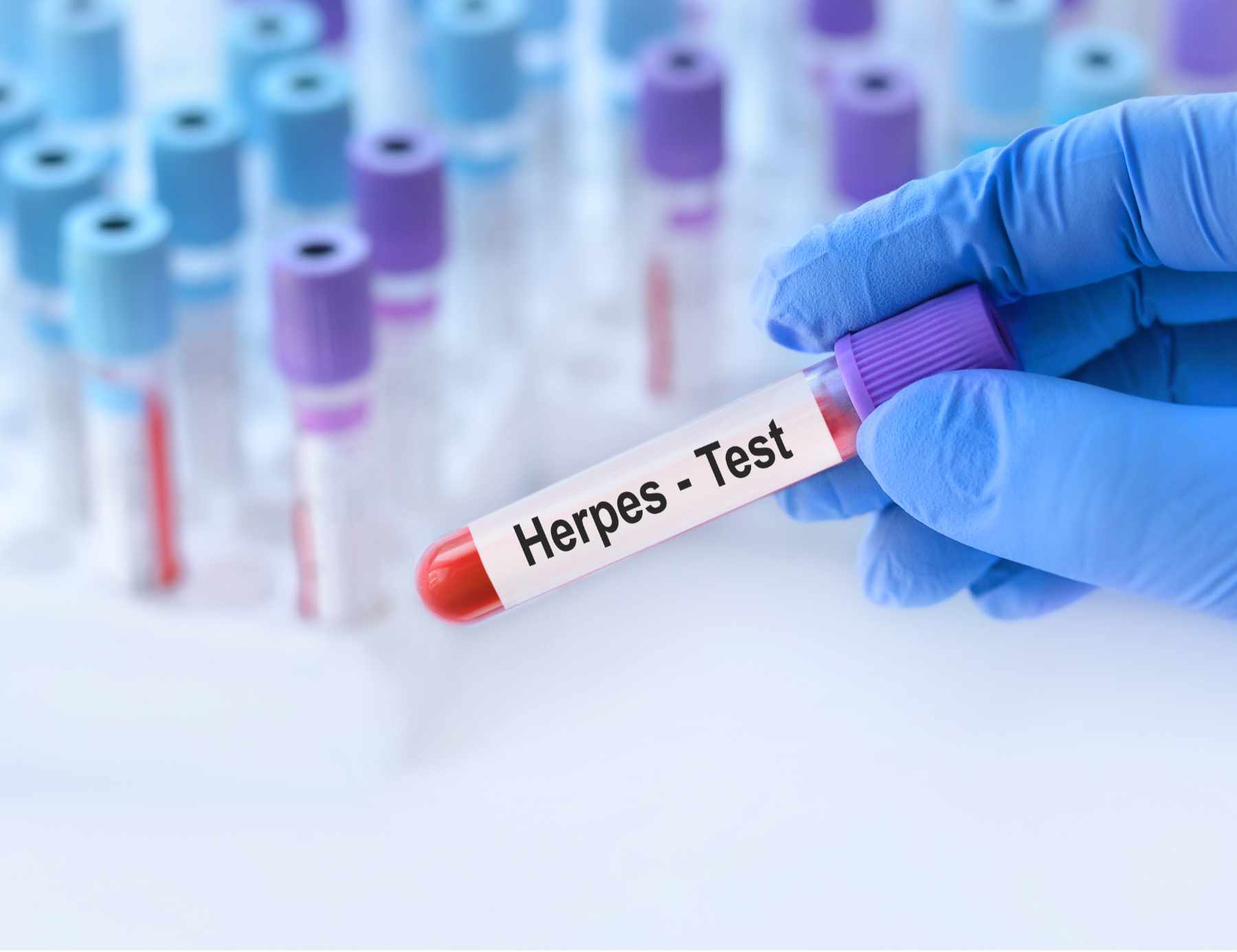Doctor holding a test blood sample tube with herpes virus test on the background of medical test tubes with analyzes