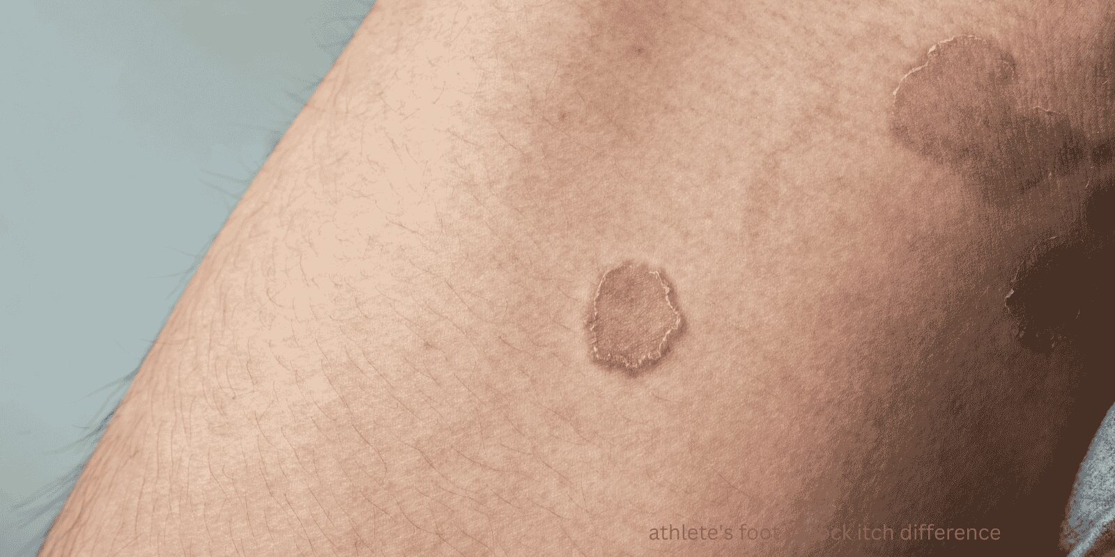 athlete's foot vs jock itch difference