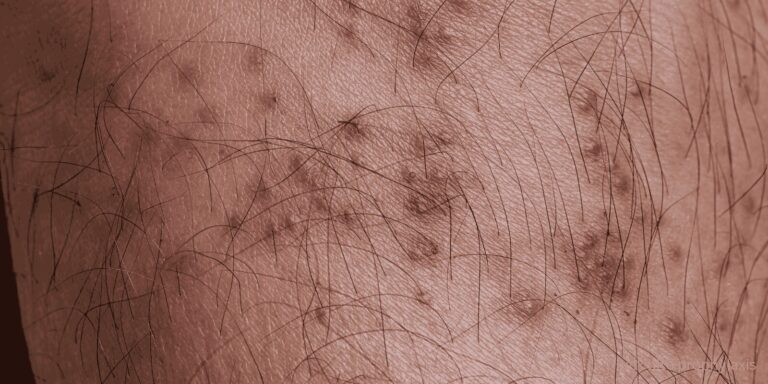 tick bite prophylaxis