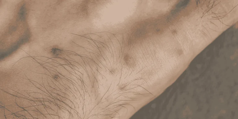 tick bites pets human health risks transmission prevention