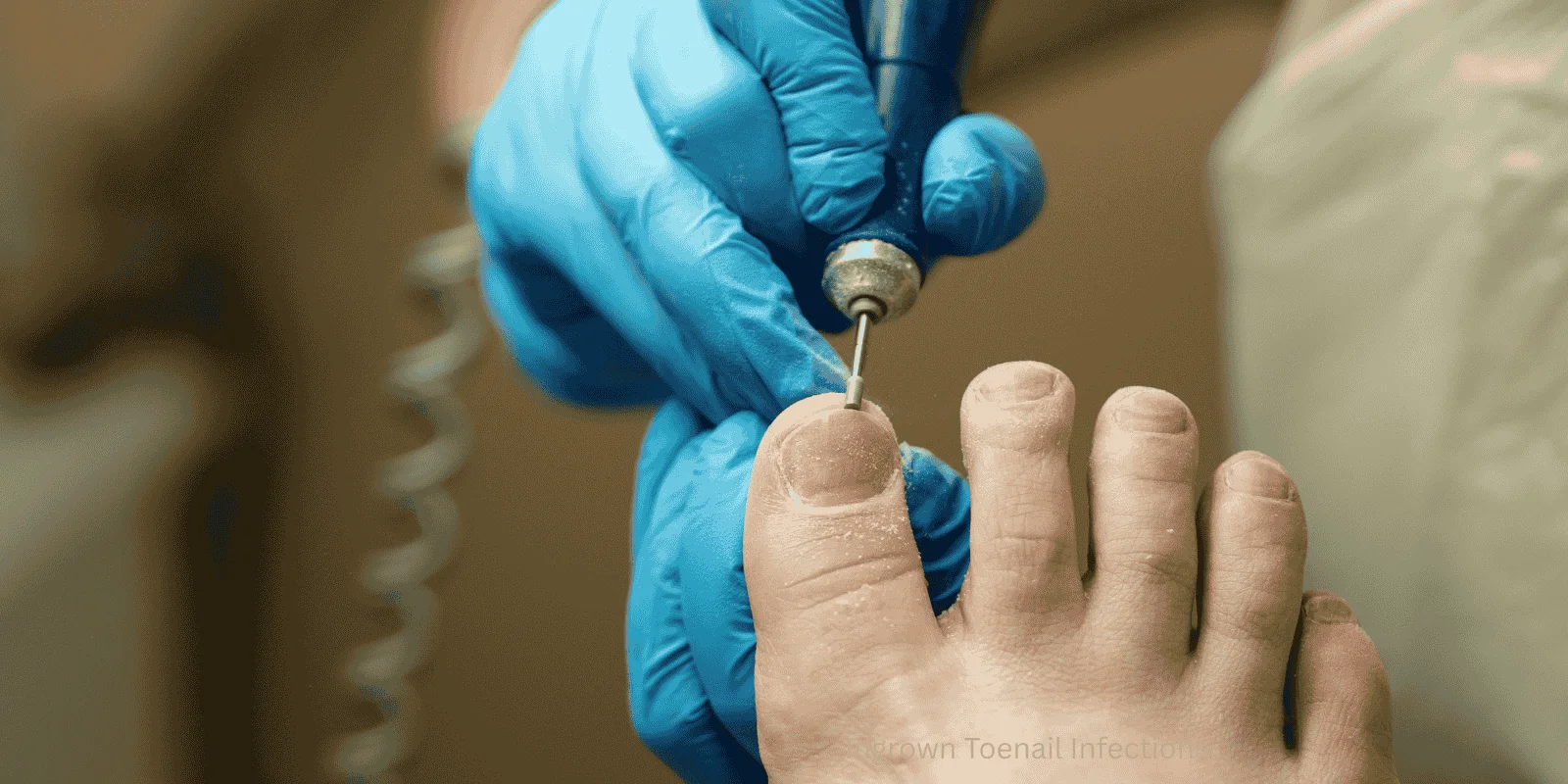 Ingrown Toenail Infections Risk Factors Prevention Causes