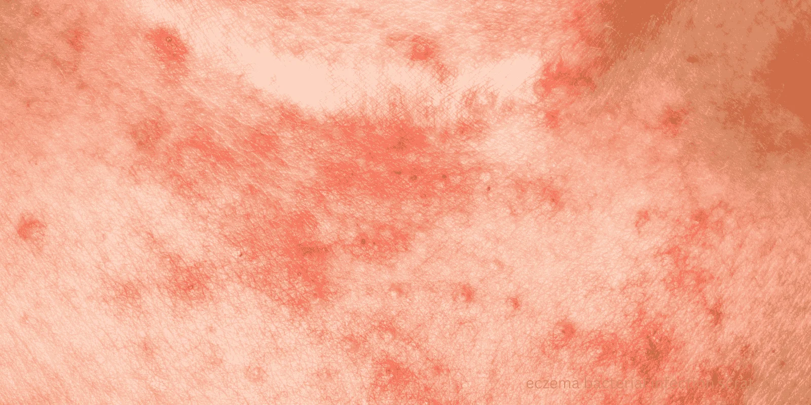 eczema bacterial infection scratching
