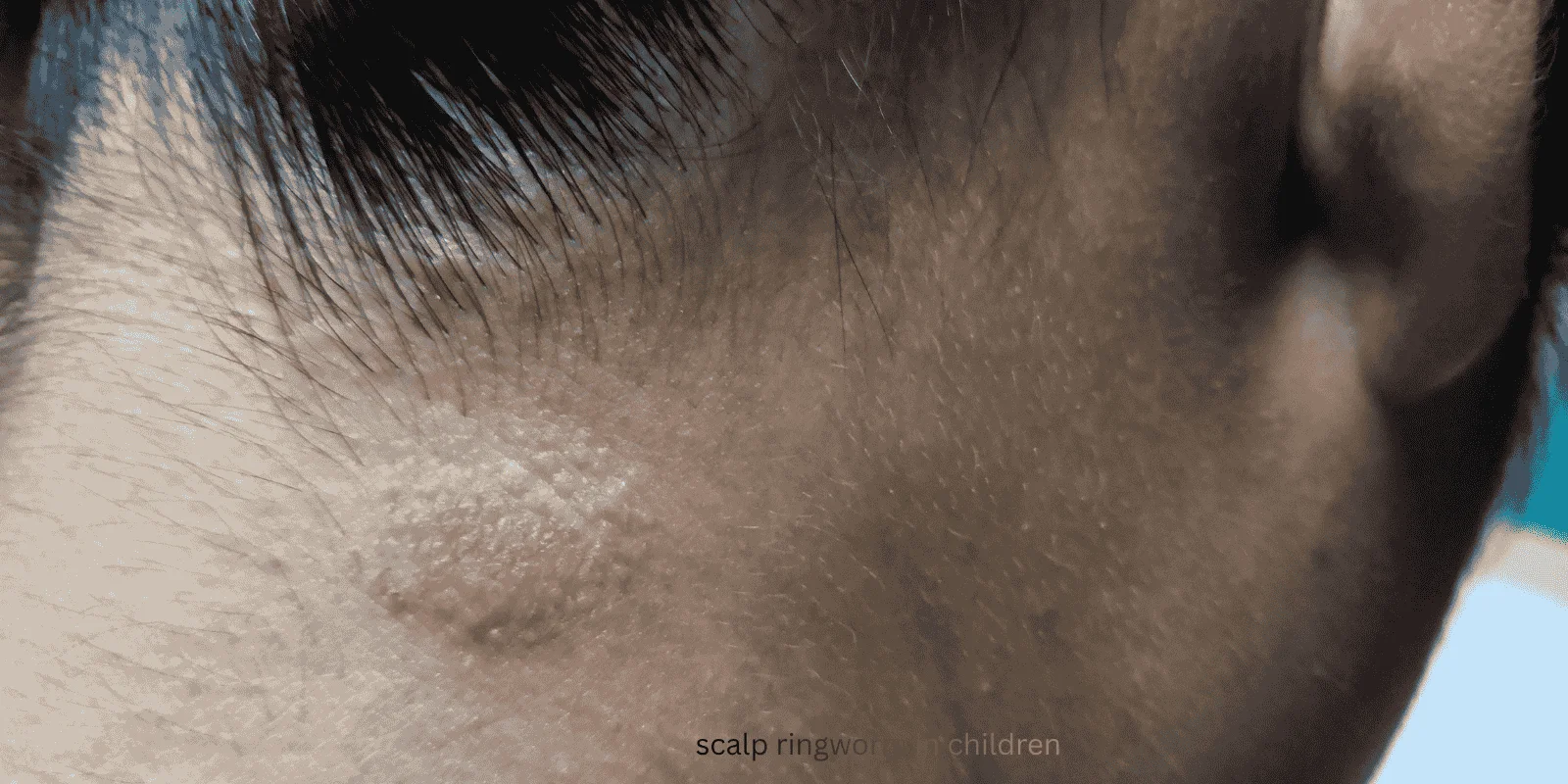 scalp ringworm in children
