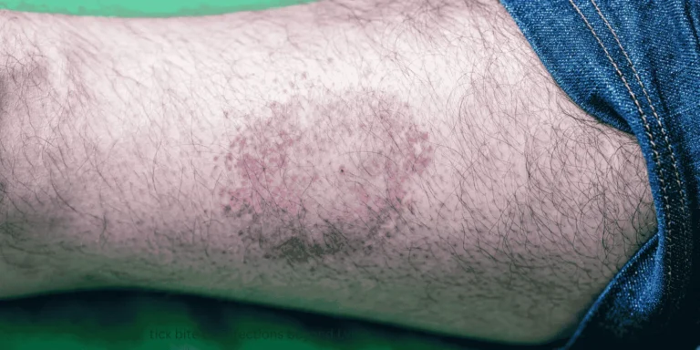 tick bite co-infections beyond Lyme