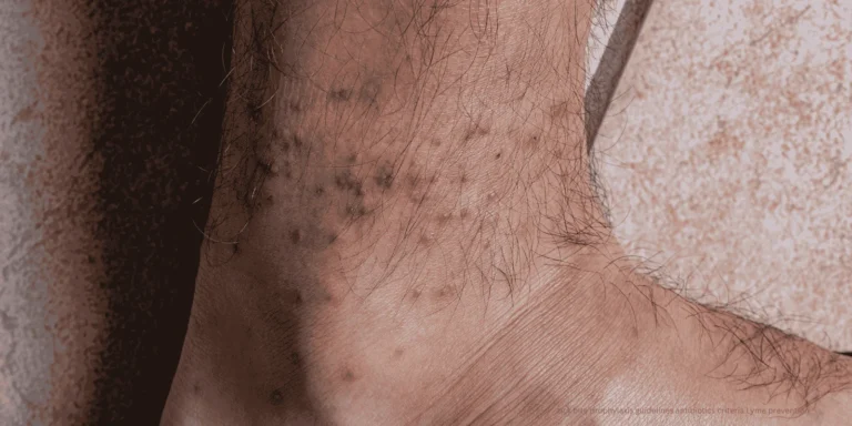 tick bite prophylaxis guidelines antibiotics criteria Lyme prevention