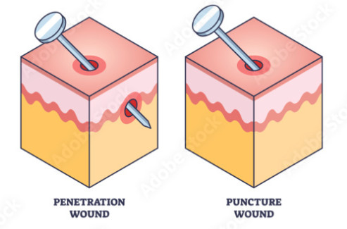 puncture-wound2
