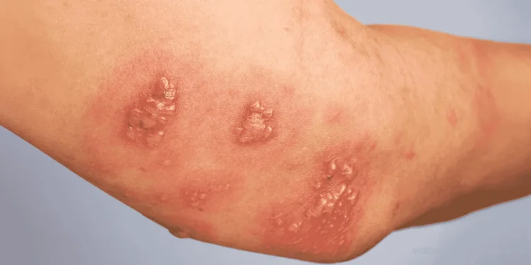 scabies vs bed bug bites