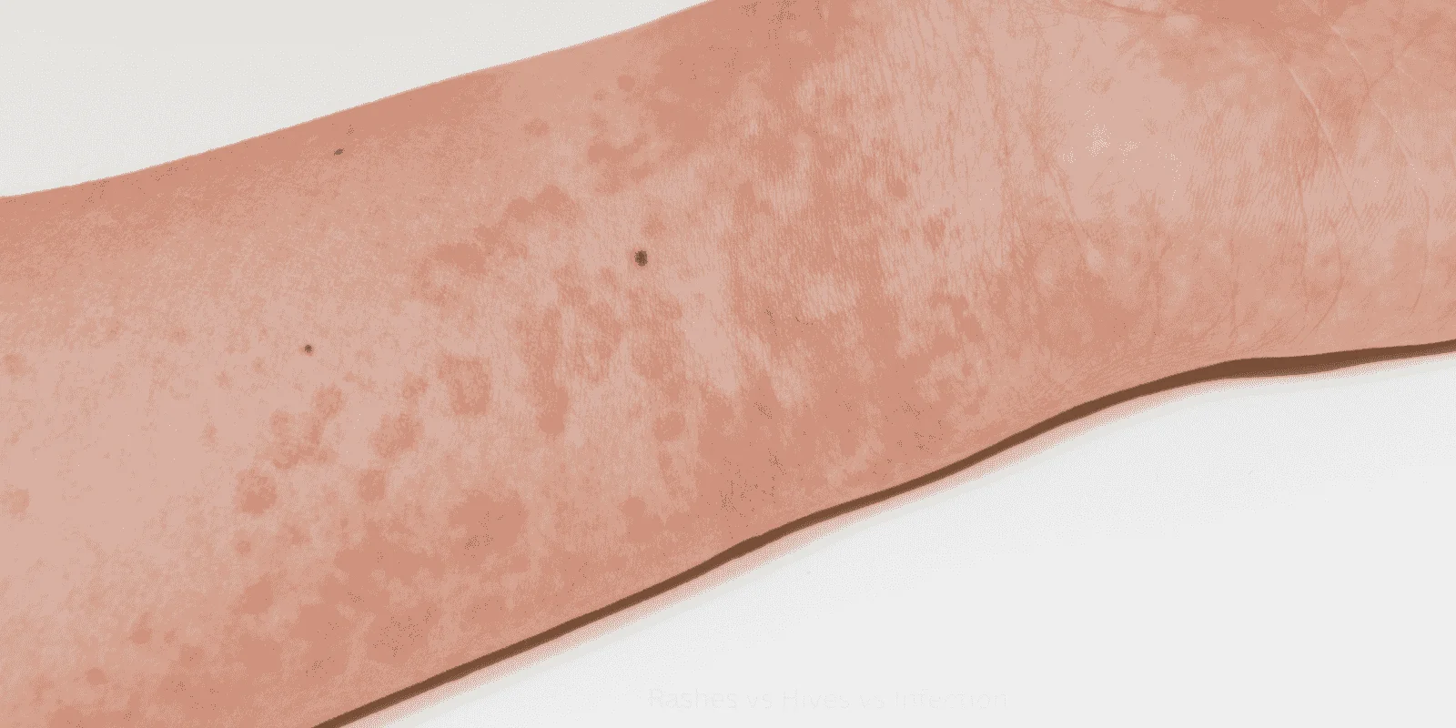 Rashes vs Hives vs Infection