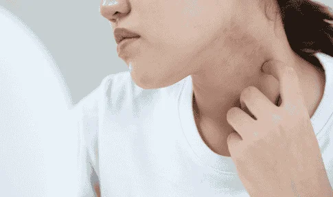 skin infections mistaken for ringworm